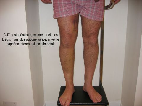 Apr&egrave;s r&eacute;sultat varices jambes