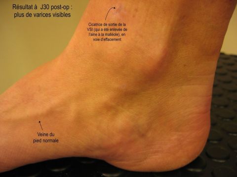 Apr&egrave;s r&eacute;sultt varice pied