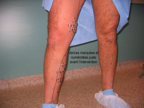 Avant r&eacute;sultat varices jambe