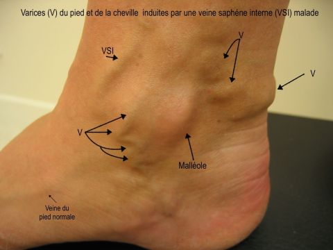 Avant r&eacute;sultat varice pied
