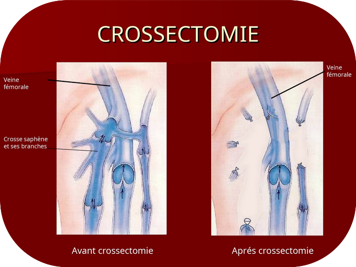 Crossectomie