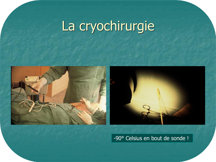 Cryochirurgie