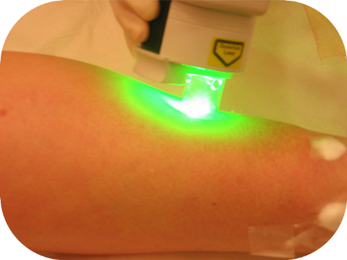 D&eacute;roulement d'un traitement laser