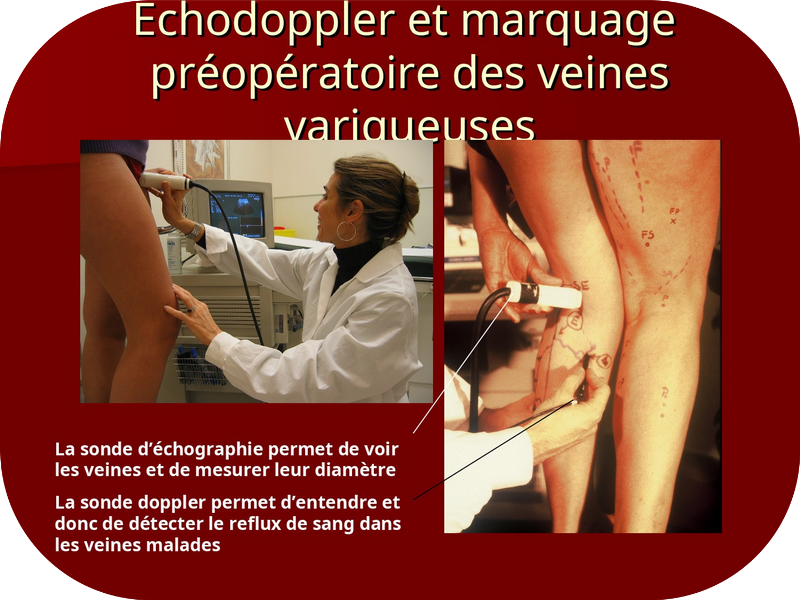 echographie marquage preoperatoire veines variqueuses
