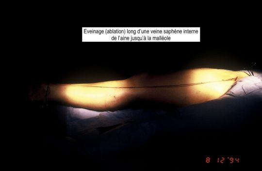 Eveinage (ablation) long d'une veine saph&egrave;ne interne de l'aine jusqu'&agrave; la mall&eacute;ole