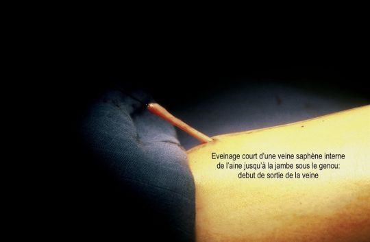 Eveinage court d'une veine saph&egrave;ne interne de l'aine 