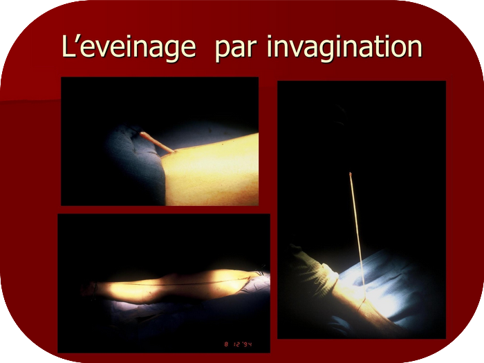 Eveinage par invagination