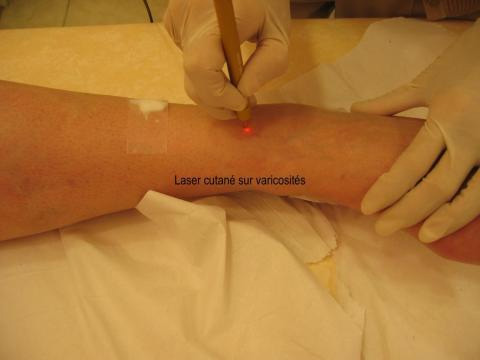 Laser cutan&eacute; sur varicosit&eacute;