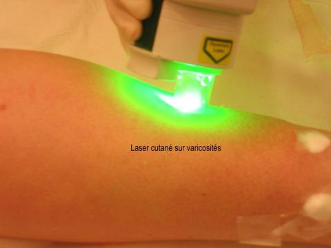 Laser cutan&eacute; sur varicosit&eacute;