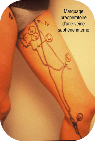 marquage preoperatoire veine saphene interne