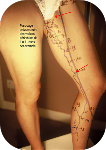 Marquage varices p&eacute;rin&eacute;ale
