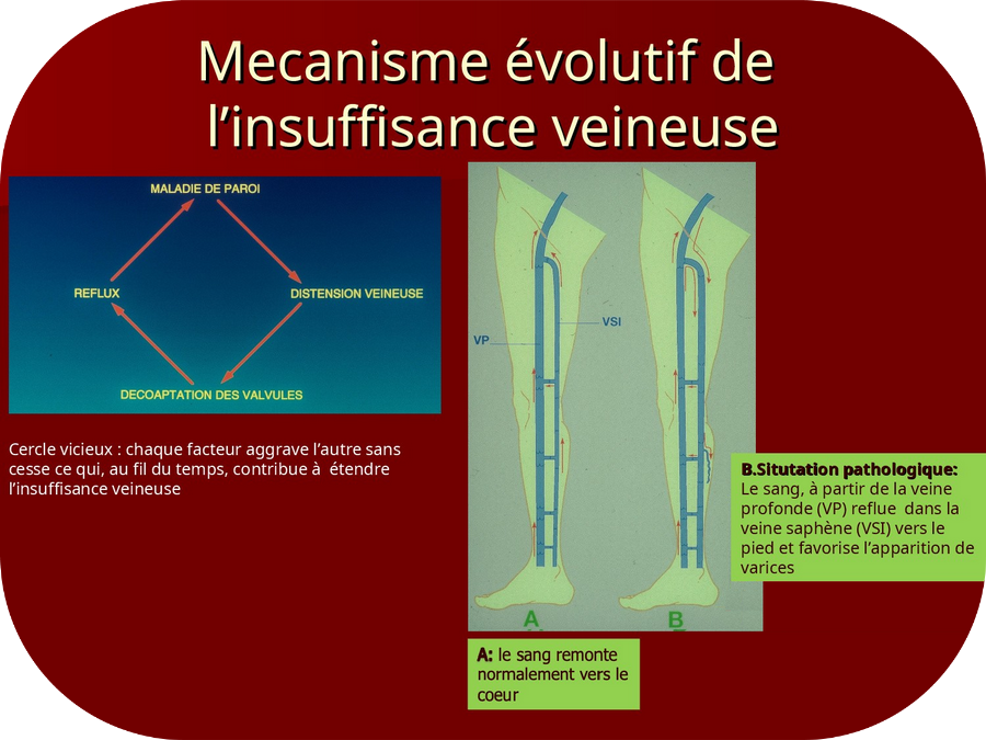 Mécanisme évolutif de l'insuffisance veineuse