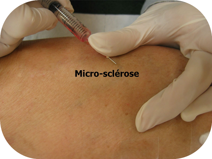Micro sclérose