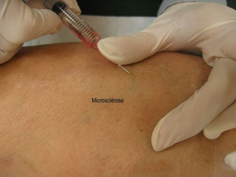 Microscl&eacute;rose