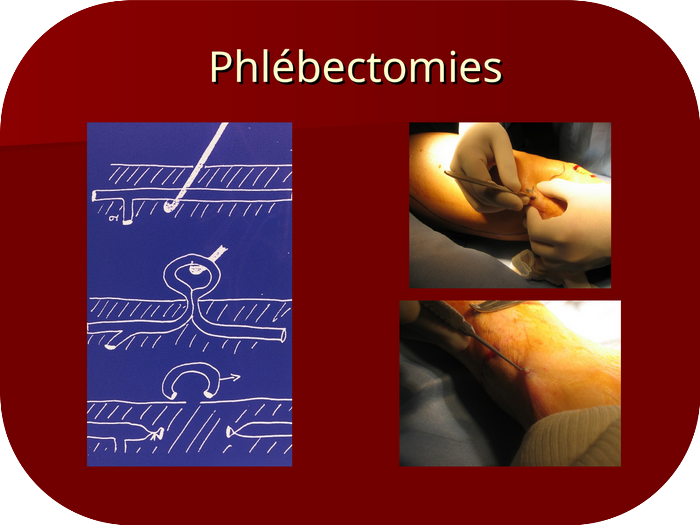 Phlébectomie