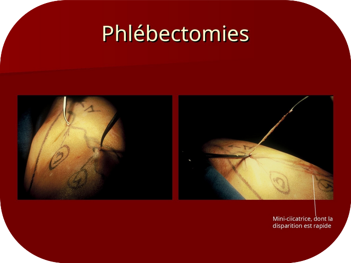 Phlébectomie