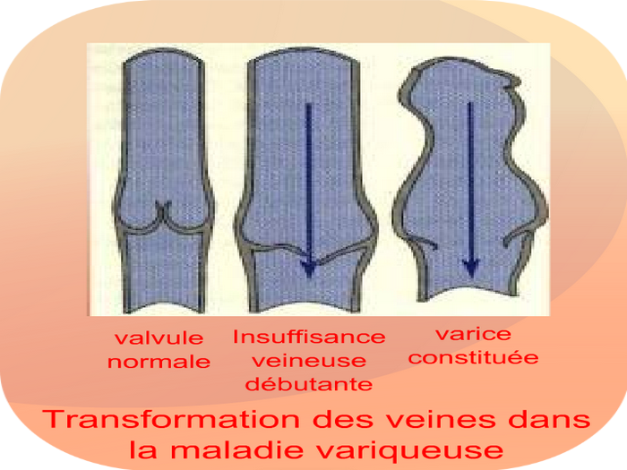 Transformation veines dans maladie variqueuse