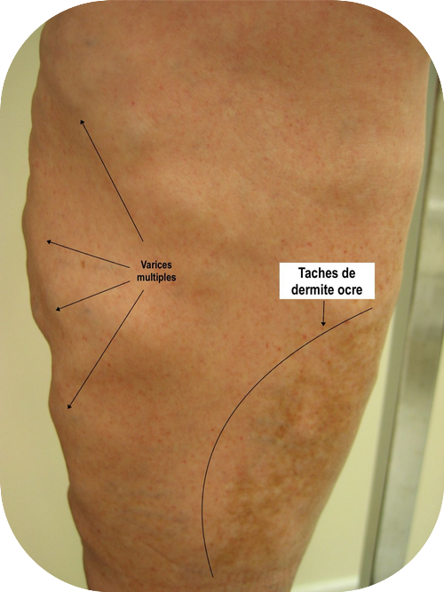 Varices multiples