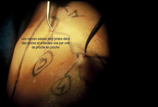 Varices saisies