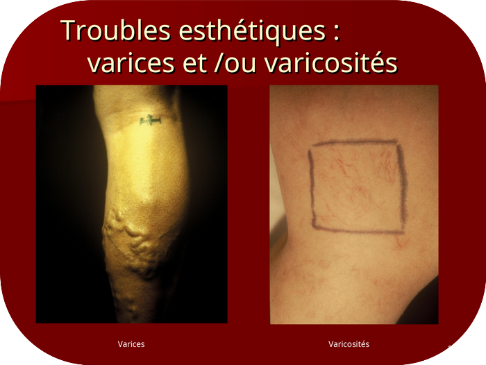 Varices / varicosités - troubles esthétique