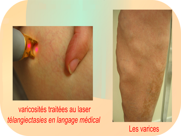 Varicosités traitées au laser