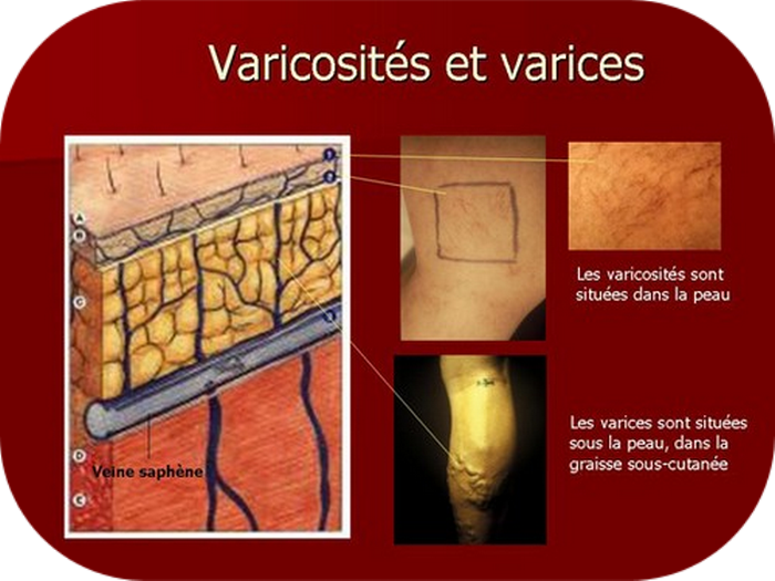 Varicosité / varices