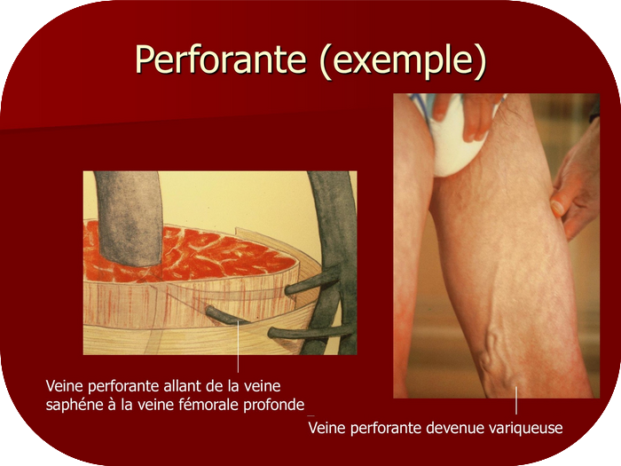 Veine parforante