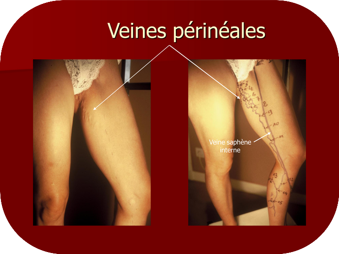 Veines p&eacute;rineales