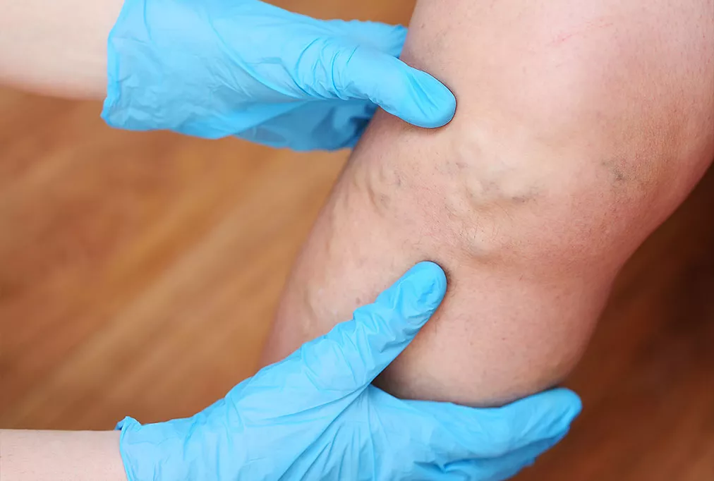 L&rsquo;heure du bilan sur les varices