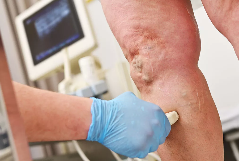 questions fr&eacute;quentes sur les varices