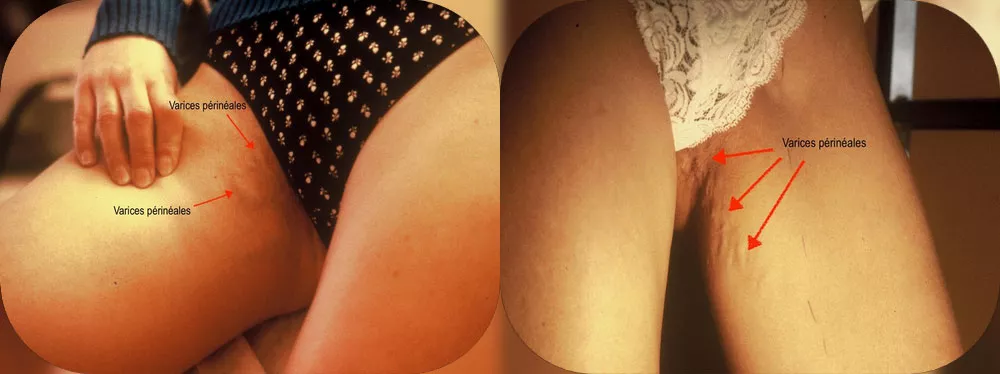 Varices de la grossesse