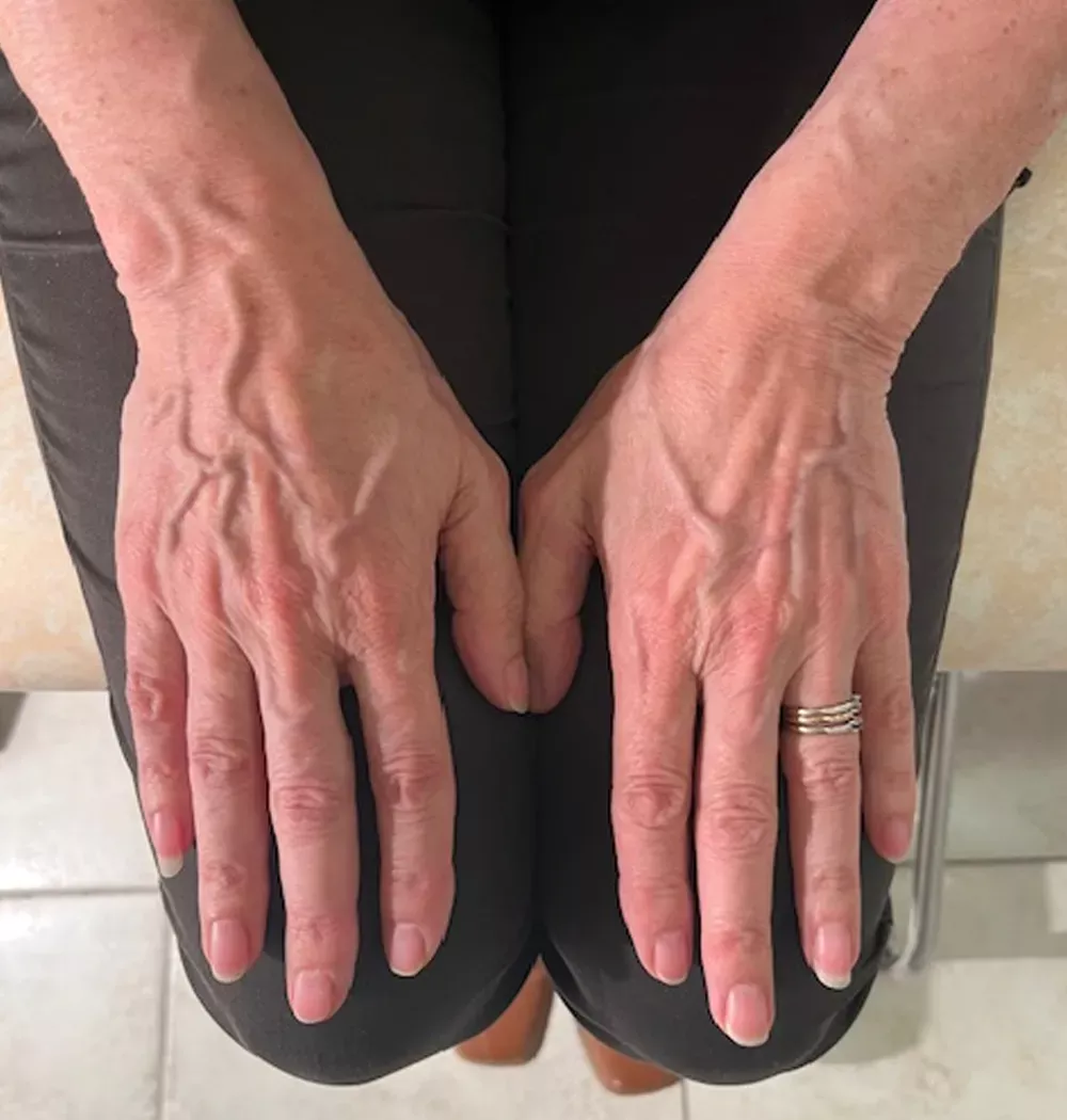Veines gonfl&eacute;es et disgracieuses