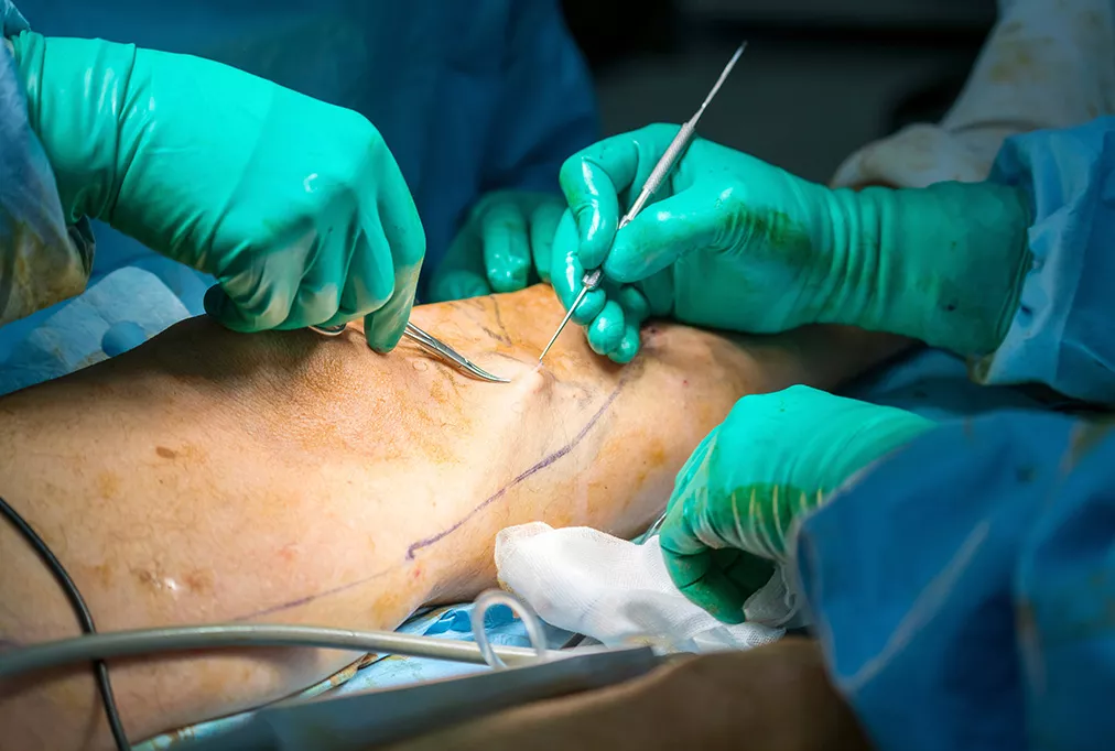 chirurgie des varices