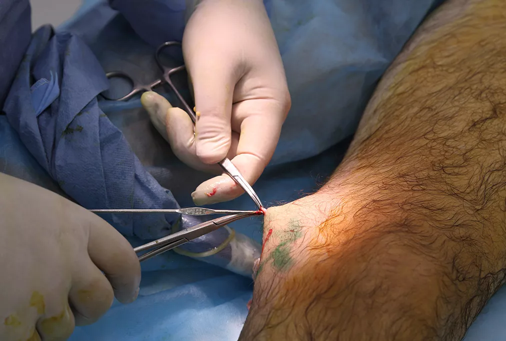 chirurgie veineuse