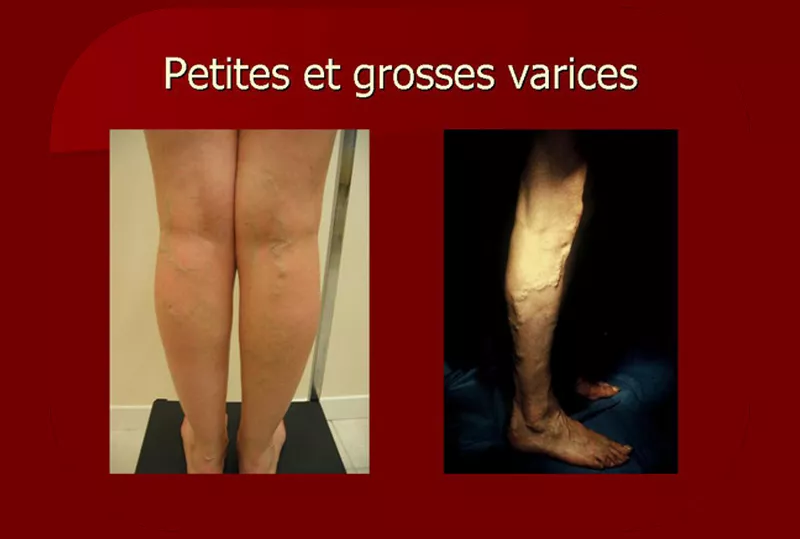 La maladie variqueuse